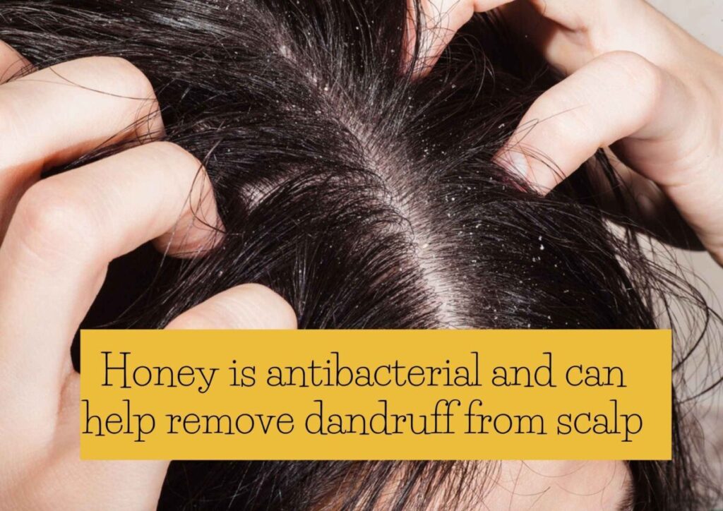 using honey for dandruff natural hair