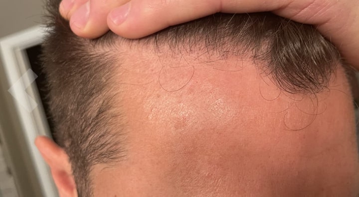 before and after folliculitis shampoo